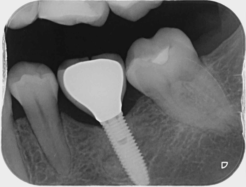 Prothèses & Implants